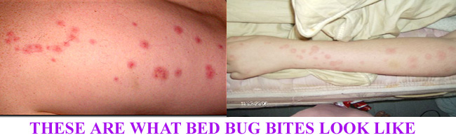 Dust Mites Bites Vs Bed Bugs Bites Images & Pictures - Becuo
